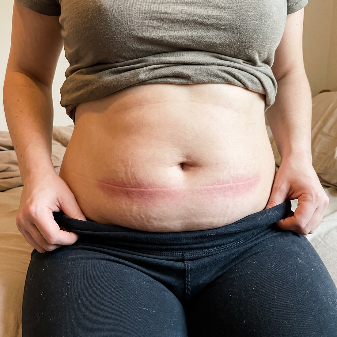 Red marks, rolled band, every single evening. Sound familiar?